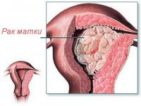 Рак эндометрия (рак тела матки)